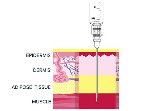 Gluteal intramuscular injection of VIVITROL®